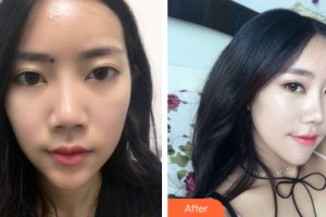 河南中醫(yī)藥大學第一附屬醫(yī)院整形美容科姜建芳整形價格表附隆鼻手術(shù)案例展示