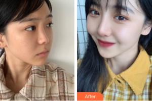 河南中醫(yī)藥大學第一附屬醫(yī)院整形美容科葛艷娜整形價格表附隆鼻手術(shù)案例展示