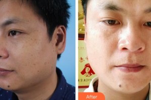 湖北武警總隊醫(yī)院醫(yī)學美容中心付俊俐整形價格表附祛斑案例展示