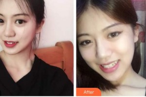 廣東醫(yī)學(xué)院附屬醫(yī)院整形外科羅少軍整形價(jià)格表附面部吸脂案例展示