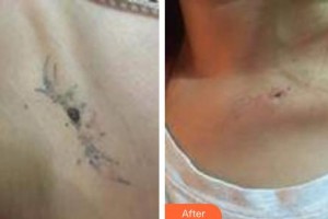 武警廣東總隊(duì)醫(yī)院整形美容中心韓業(yè)威整形價(jià)格表附激光去紋身案例展示