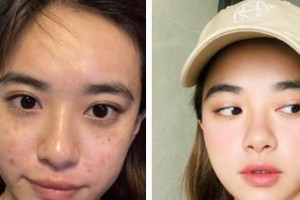 廣東藥學(xué)院附屬第一醫(yī)院激光整形美容外科楊曙整形價(jià)格表附激光祛斑案例展示