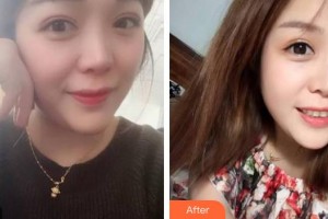 廣東藥科大學(xué)附屬第三醫(yī)院整形美容科馮澤宇整形價(jià)格表附牙齒隱形矯正案例展示