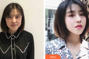 海南整形美容醫(yī)院楊洪波整形價格表附皮膚美容案例展示