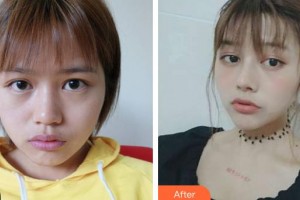 云南銅雀臺(tái)整形美容醫(yī)院陶俊院長(zhǎng)整形價(jià)格表附鼻部綜合案例展示