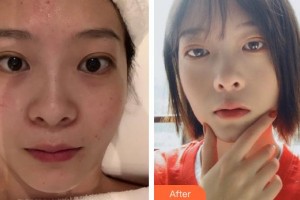 云南華美美萊美容醫(yī)院俞滿(mǎn)昌整形價(jià)格表附水氧活膚案例展示