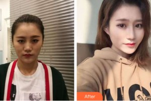 海南整形美容醫(yī)院劉永忠整形價格表附隆鼻手術(shù)案例展示