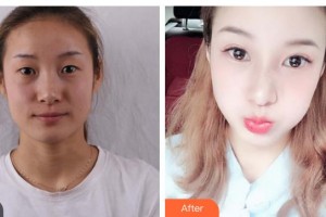 云南瑪麗亞整形美容醫(yī)院陳志棟整形價(jià)格表附切開(kāi)雙眼皮案例展示