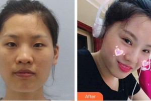 武警云南省邊防總隊(duì)醫(yī)院整形美容中心石林整形價(jià)格表附切開(kāi)雙眼皮案例展示