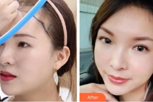 武警云南省邊防總隊(duì)醫(yī)院整形美容中心尹煒能整形價(jià)格表附種植發(fā)際線案例展示