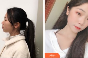 海南省人民醫(yī)院激光美容整形科林遐整形價格表附皮膚美容案例展示