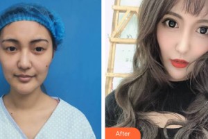 海南省皮膚病醫(yī)院激光整形美容中心翟培明整形價格表附眼部手術(shù)案例展示