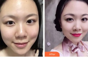 云南華美美萊美容醫(yī)院楊光整形價(jià)格表附祛斑祛痣案例展示