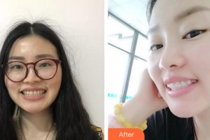 海南南方天涯口腔醫(yī)院陳蘭整形價(jià)格表附牙齒矯正案例展示