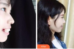 云南竹子口腔醫(yī)院趙志平整形價(jià)格表附隱形托槽矯正案例展示