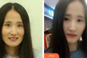 云南竹子口腔醫(yī)院萬(wàn)碧濤整形價(jià)格表附牙齒陶瓷矯正案例展示