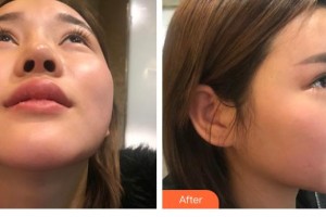 云南銅雀臺(tái)整形美容醫(yī)院顏?zhàn)釉普蝺r(jià)格表附鼻部綜合案例展示