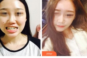 云南高原皮膚病醫(yī)院楊景平整形價(jià)格表附面部矯正案例展示