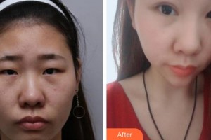 云南省第一人民醫(yī)院眼科李曉亮整形價(jià)格表附眼部綜合案例展示