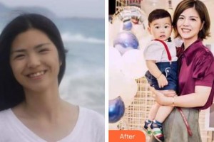 云南省第一人民醫(yī)院眼科汪潔整形價(jià)格表附牙齒隱形矯正案例展示