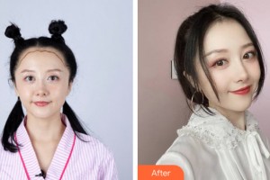 海南美媛醫(yī)學(xué)美容門診部杜洛鋒整形價(jià)格表附植發(fā)案例展示