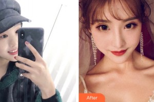 海南菲思卡爾醫(yī)學美容門診部肖鵬整形價格表附眼部手術(shù)案例展示