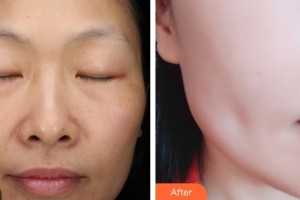 昆明愛萊美醫(yī)療美容醫(yī)院焦廣銀整形價(jià)格表附光子嫩膚案例展示