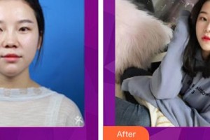 昆明夢(mèng)想醫(yī)療美容醫(yī)院胡凱整形價(jià)格表附耳軟骨復(fù)合隆鼻案例展示