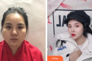 昆明赫柏醫(yī)療美容門診部劉傳君整形價格表附面部吸脂案例展示