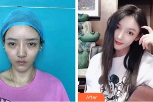 昆明麗都醫(yī)療美容醫(yī)院李喜永整形價(jià)格表附假體墊眉弓案例展示