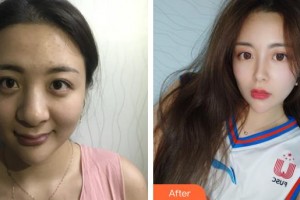 昆明吳氏嘉美美容醫(yī)院劉洋整形價(jià)格表附鼻部綜合案例展示