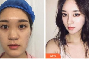 昆明麗都醫(yī)療美容醫(yī)院姜海燕整形價(jià)格表附鼻部綜合案例展示