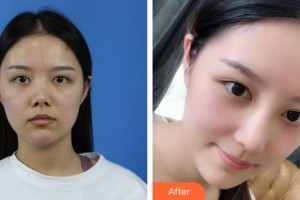 昆明天倫婦產(chǎn)醫(yī)院醫(yī)學(xué)整形美容中心蘭娜整形價(jià)格表附微針美膚案例展示