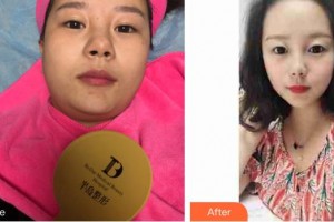 昆明維多利亞醫(yī)療美容醫(yī)院茶文麗整形價(jià)格表附微針?biāo)獍咐故?>
</a>
<h3 class=