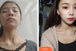 昆明愛萊美醫(yī)療美容醫(yī)院李元駿整形價格表附鼻部綜合案例展示