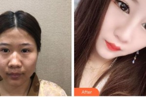 昆明韓辰整形醫(yī)院肖育亮整形價格表附鼻部綜合案例展示