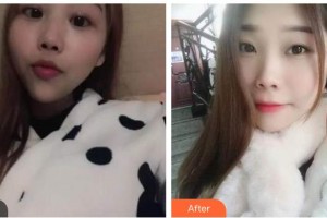 整形醫(yī)院胡靖整形價(jià)格表附自鎖托槽矯正案例展示