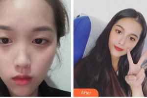 整形醫(yī)院唐俊整形價(jià)格表附鼻部綜合案例展示