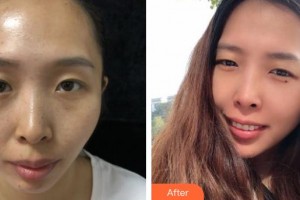 昆明夢(mèng)想醫(yī)療美容醫(yī)院黎洪棉整形價(jià)格表附去痘印痘坑案例展示