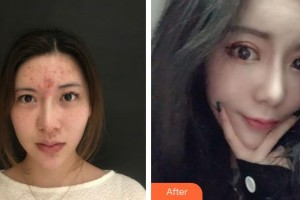 昆明都市儷人美容醫(yī)院李關文整形價格表附隆鼻案例展示