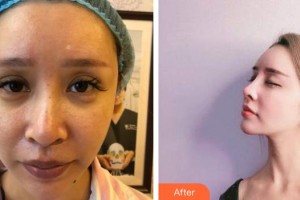 昆明美立方（原大華）醫(yī)療美容醫(yī)院高丹整形價格表附鼻修復案例展示