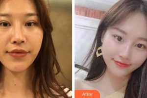 昆明夢想醫(yī)療美容醫(yī)院祝勇整形價(jià)格表附激光祛斑案例展示