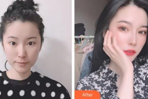 昆明達(dá)美醫(yī)療美容診所楊光華整形價(jià)格表附切開雙眼皮案例展示