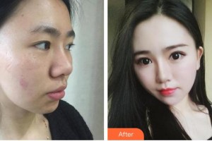 昆明韓辰整形醫(yī)院周楊洋整形價(jià)格表附內(nèi)切祛眼袋案例展示