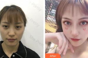 昆明前衛(wèi)美眼整形?？圃\所吳瓊整形價(jià)格表附切開雙眼皮案例展示