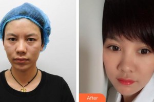 昆明璀璨人生醫(yī)療美容診所李鴻軍整形價格表附切開雙眼皮案例展示