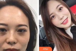 昆明夢想醫(yī)療美容醫(yī)院張燕雄整形價格表附激光去黑眼圈案例展示