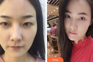 昆明同仁醫(yī)院醫(yī)療美容科趙亞南整形價格表附眼部綜合案例展示