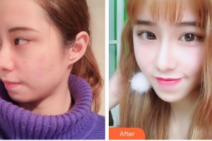 昆明璽蘭醫(yī)療美容診所劉斌整形價(jià)格表附眼部綜合案例展示