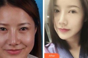 昆明同仁醫(yī)院醫(yī)療美容科劉景楨整形價(jià)格表附眼部綜合案例展示